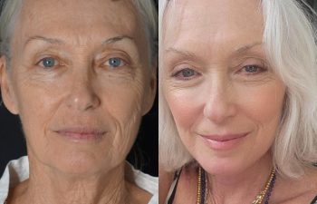 64-years-young, had never had a facial rejuvenation procedure before. She did her research and talked to plastic surgeons all over before she fell in love with our natural, refreshing results. Dawn opted for our signature EVELift® + volume restoration with fat.