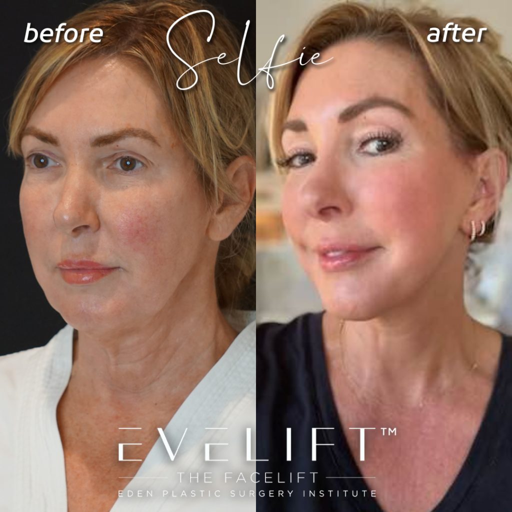 60-years-young, flew all the way from Houston, TX, for her EVE Lift™️ + smart peel laser resurfacing.