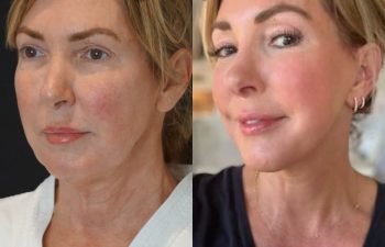 60-years-young, flew all the way from Houston, TX, for her EVELift® + smart peel laser resurfacing.
