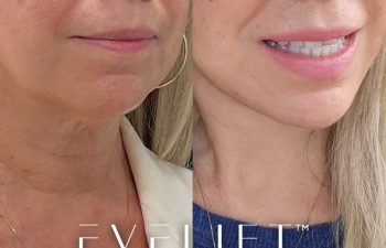 60-years-young, came all the way from Ohio for her EVELift® + volume restoration with fat.