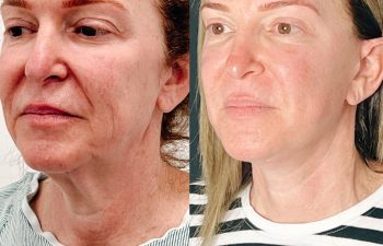 female patient before and after EVELift®