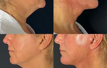 female patient before and after EVELift®