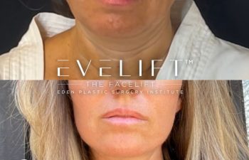 female patient before and after EVELift®