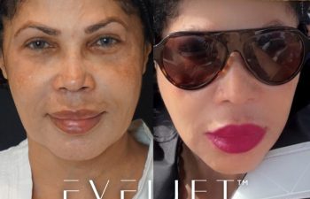 48-years-young, just a little over a month post-op, as she enjoys the waters from a boat.