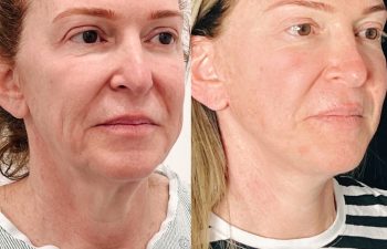 female patient before and after EVELift®