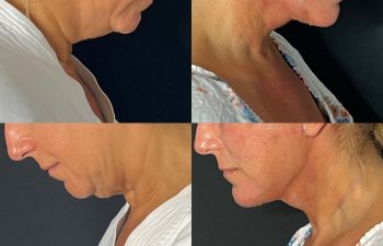 female patient before and after EVELift®