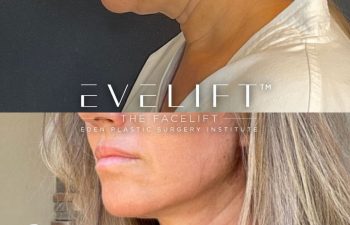 female patient before and after EVELift®
