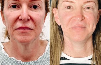 female patient before and after EVELift®