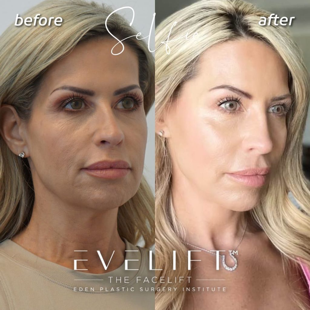 female patient before and after EVE Lift™️
