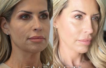 female patient before and after EVELift®
