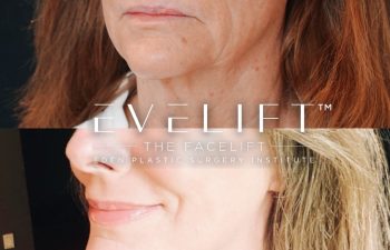 female patient before and after EVELift®