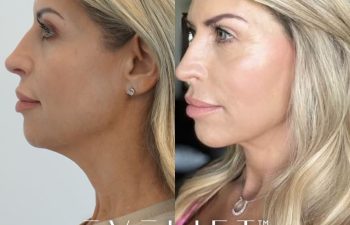 female patient before and after EVELift®