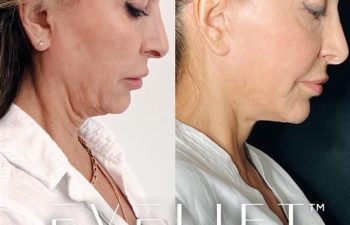 female patient before and after EVELift®