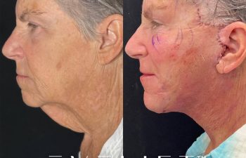 female patient before and after EVELift®