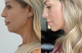 female patient before and after EVELift®