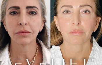 female patient before and after EVELift®