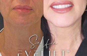female patient before and after EVELift®