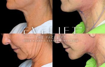 female patient before and after EVELift® + volume restoration with fat