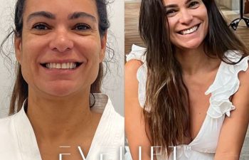 female patient before and after EVELift®