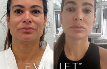 female patient before and after EVELift®