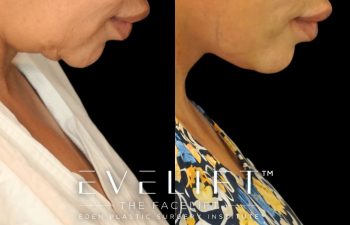 female patient before and after EVELift®