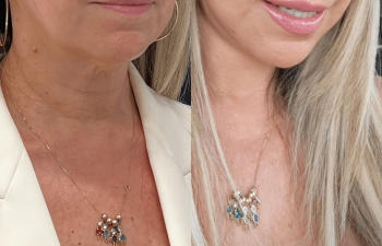 female patient before and after EVELift® + volume restoration with fat