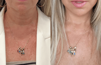 female patient before and after EVELift® + volume restoration with fat