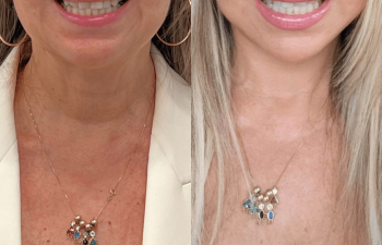female patient before and after EVELift® + volume restoration with fat