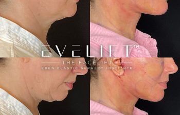 female patient before and after EVELift® + volume restoration with fat