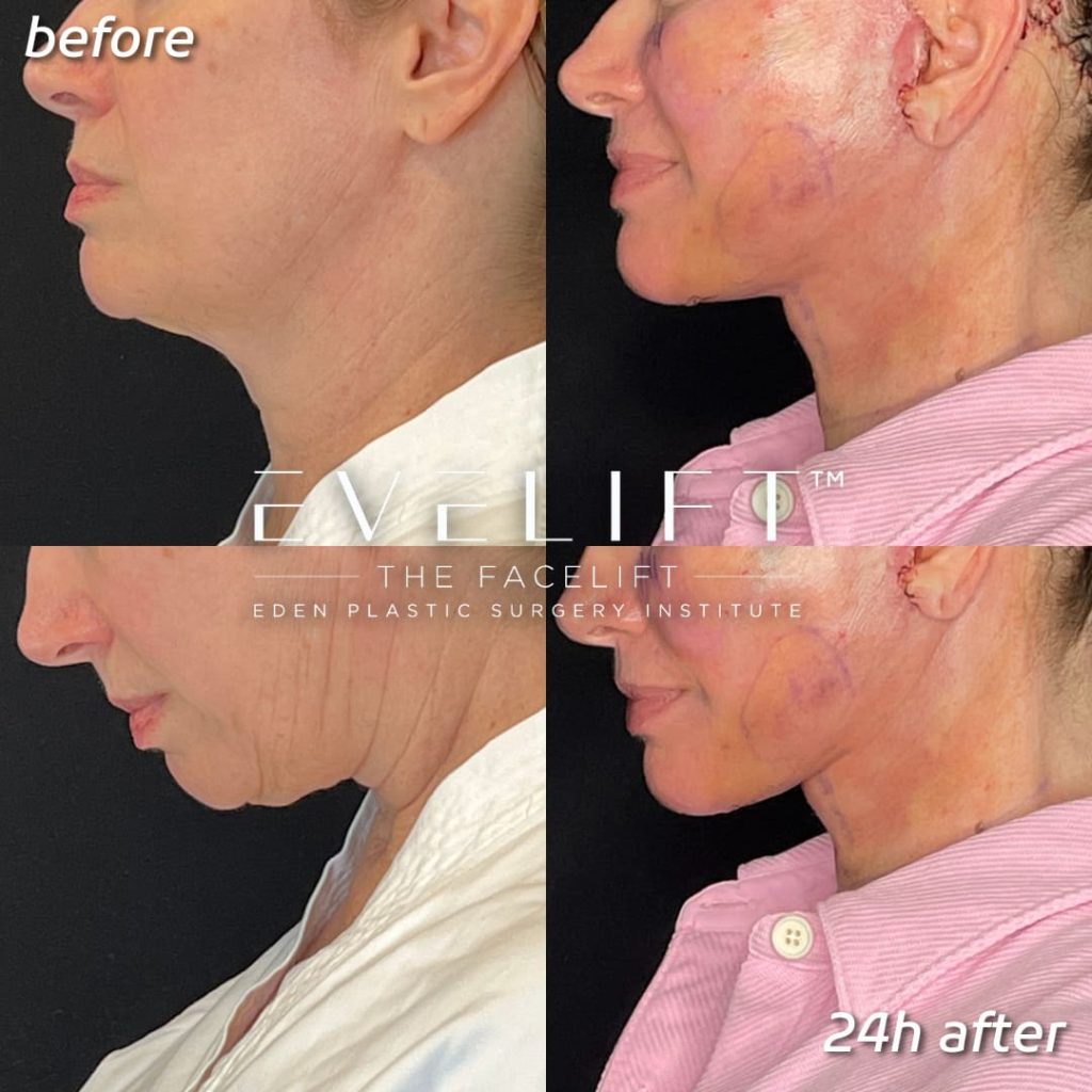 female patient before and after EVE Lift™️ + volume restoration with fat