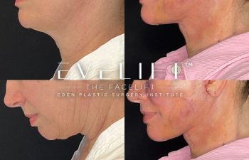 female patient before and after EVELift® + volume restoration with fat