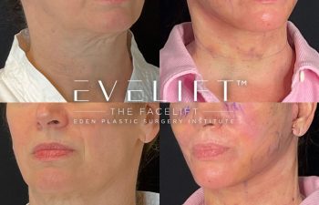 female patient before and after EVELift® + volume restoration with fat
