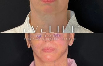 female patient before and after EVELift® + volume restoration with fat