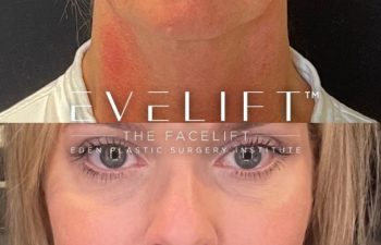 female patient before and after EVELift®