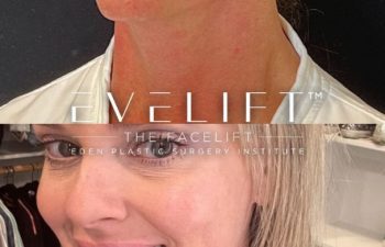 female patient before and after EVELift®