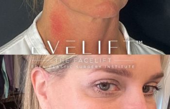 female patient before and after EVELift®