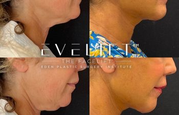 female patient before and after EVELift®