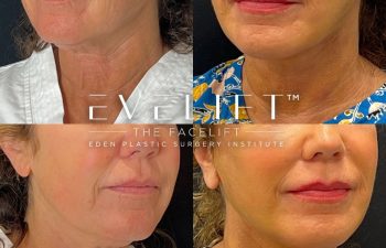 female patient before and after EVELift®
