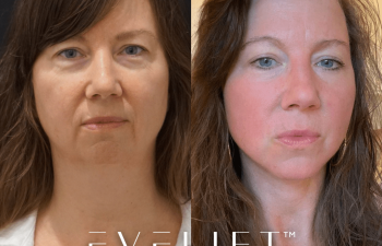 female patient before and after EVELift® + volume restoration with fat