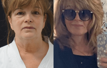 female patient before and after EVELift® + volume restoration with fat