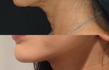 female patient before and after EVELift®