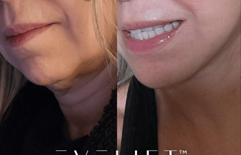female patient before and after EVELift® + volume restoration with fat