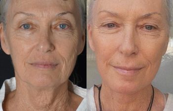 female patient before and after EVELift® + volume restoration with fat