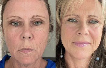 female patient before and after EVELift® + volume restoration with fat