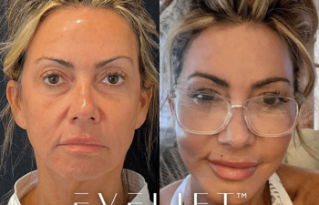 female patient before and after EVELift® + volume restoration with fat
