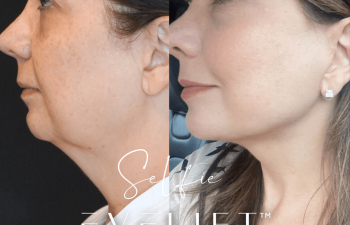 female patient before and after EVELift® + volume restoration with fat