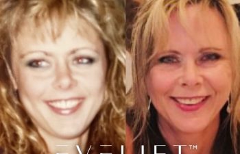 female patient before and after EVELift®