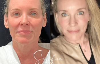 female patient before and after EVELift® + volume restoration with fat