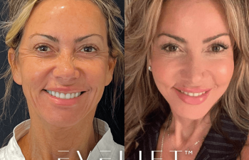 female patient before and after EVELift® + volume restoration with fat