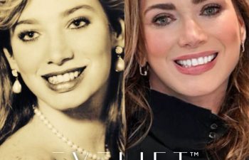 female patient before and after EVELift®